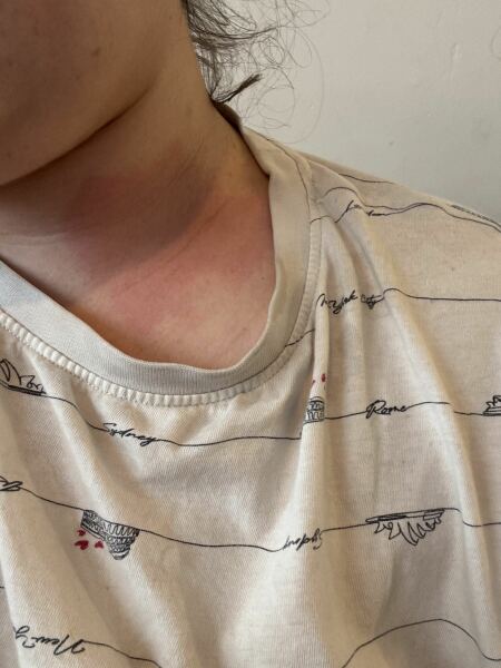 Skin reaction - gardening
