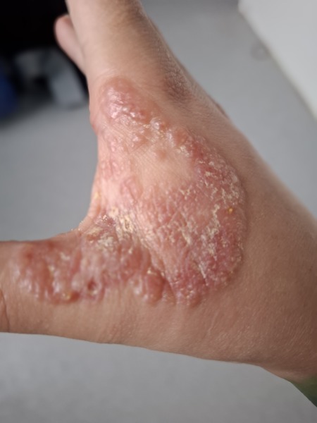 Anyone got hashimotos disease? Just been diagnosed and have so many questions.