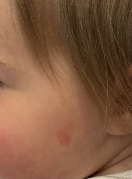 Can slapped cheek be this mild?!