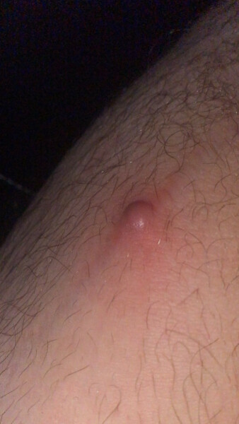 Smooth red Lump on thigh, Anyone know what this is?