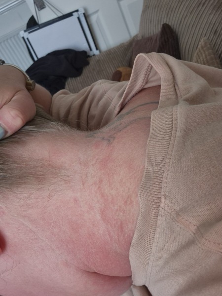 Pityriasis rosea