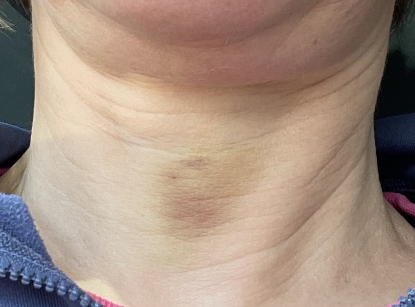 Unexplained bruise on neck