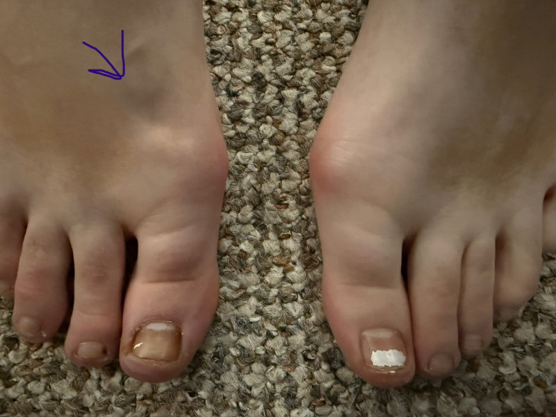 What wrong with her toe?