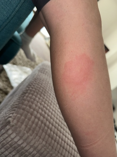 Can you help me identify this bite or sting?