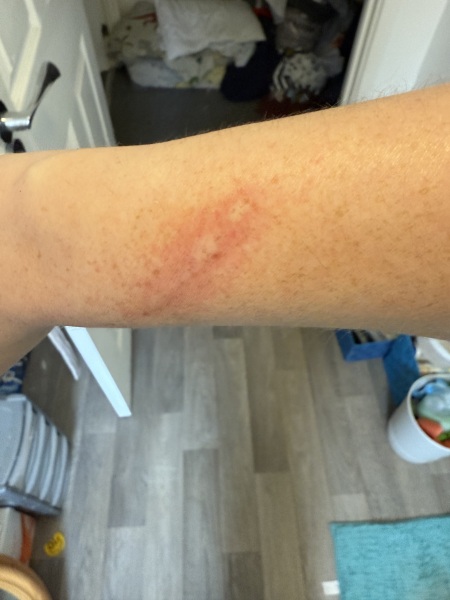 Burnt arm- advice.