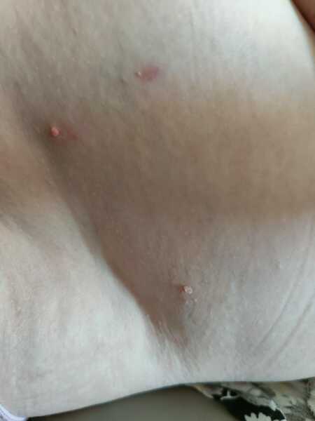 Molluscum contagiosm 