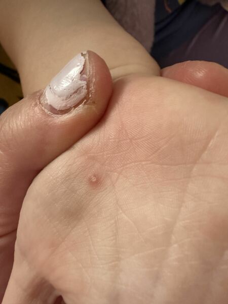 Is this a wart on hand ?!