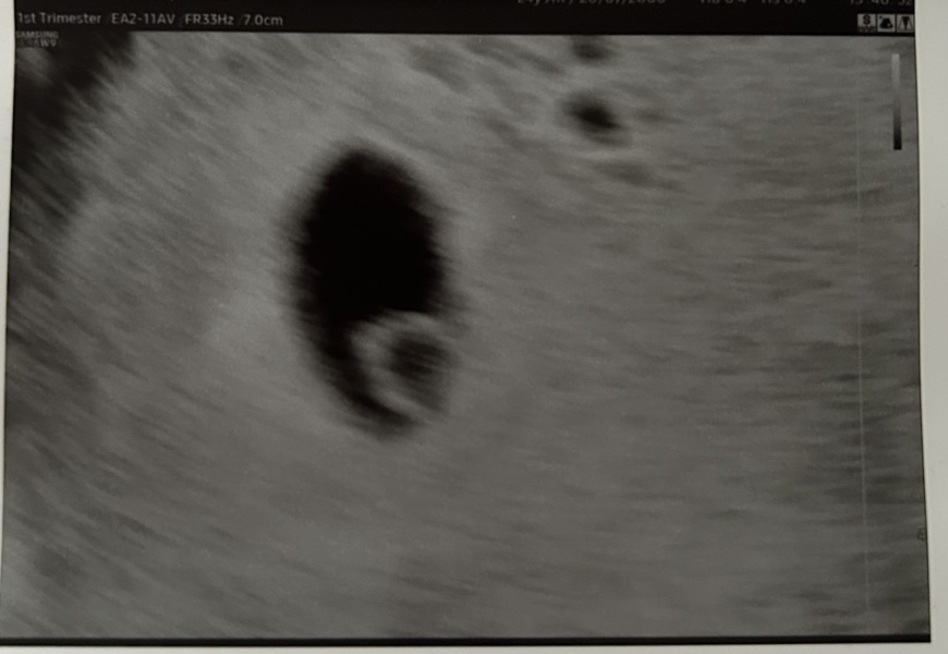 Pregnancy and ultrasound (perhaps molar?)