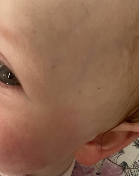 Petechiae on toddlers face
