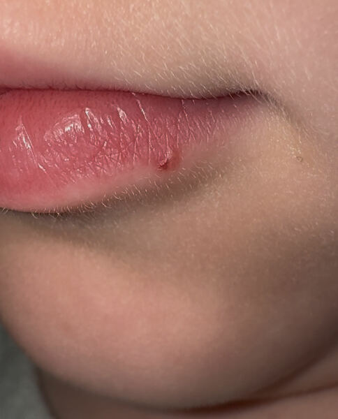 Is this a cold sore?