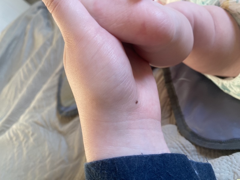 A red mark on baby’s foot.