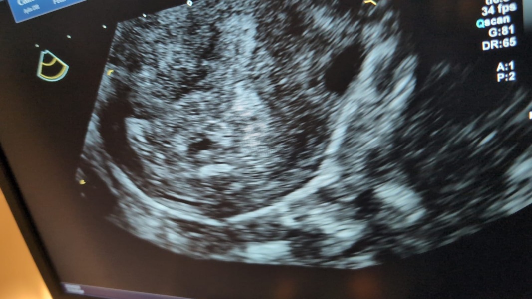 4th missed miscarriage?