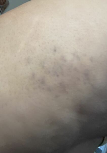 Bruising from itching