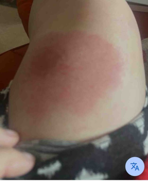 What has bitten me?!