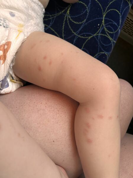 Weird rash on 2yr old toddler