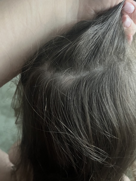 Bald spots on my 3.5 year old girls head