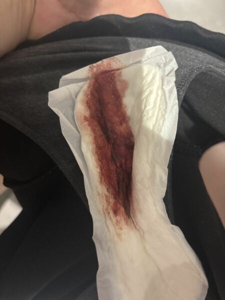 Too much blood after a stretch and sweep? (TMI image warning)