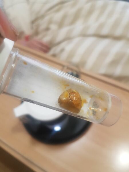 Just got home from gallbladder surgery