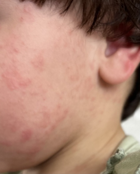 Reoccurring rash on 1 year old