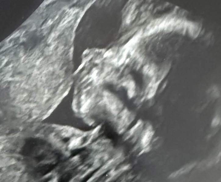 Do you think it is a cleft lip?