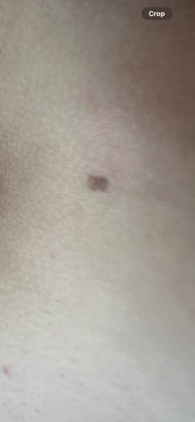 Mole worry
