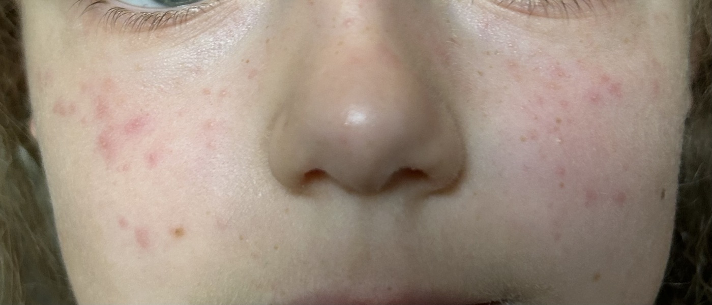 Funny spots under eyes