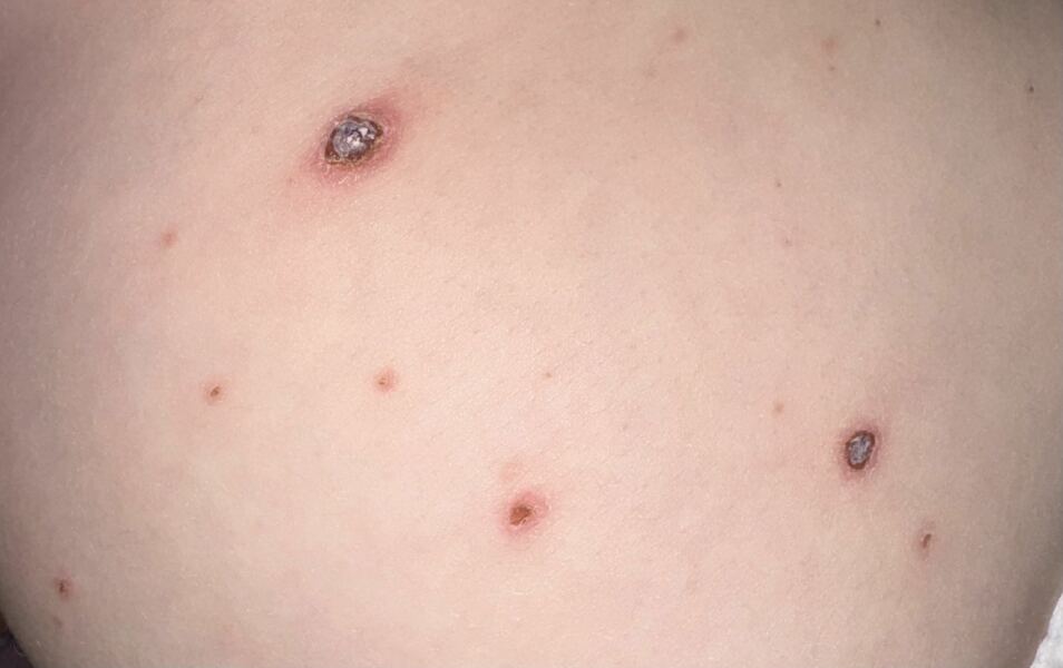 Chicken pox infected?