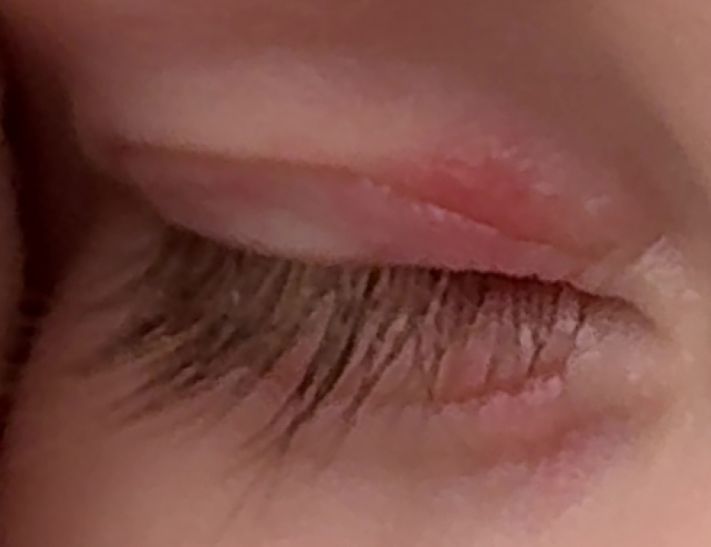 11 month old has red patch on eye