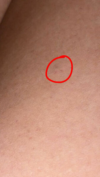 Worried I have soft tissue sarcoma