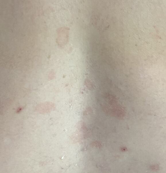 Rash