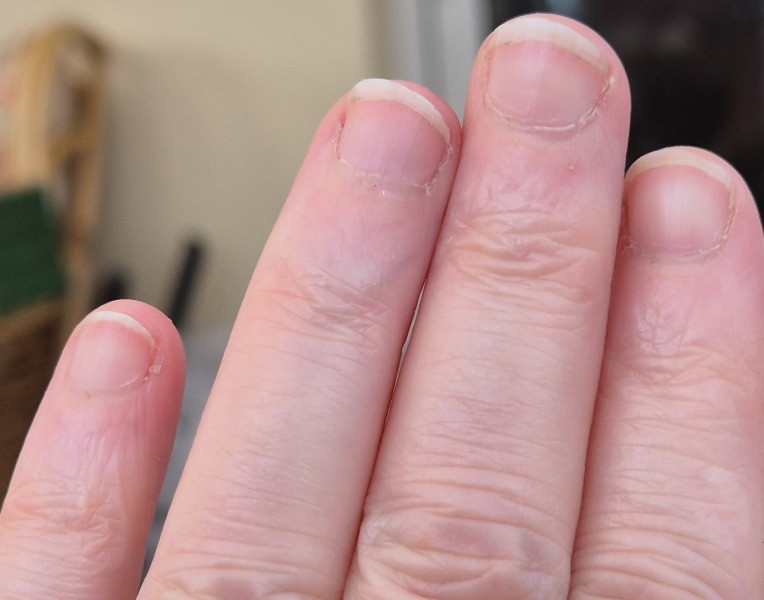 Pale fingernails