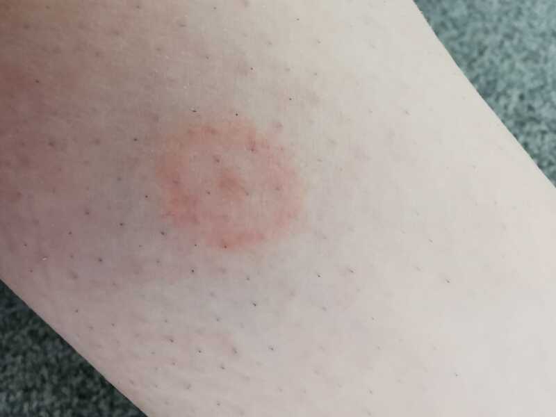 Is this a tick bite?