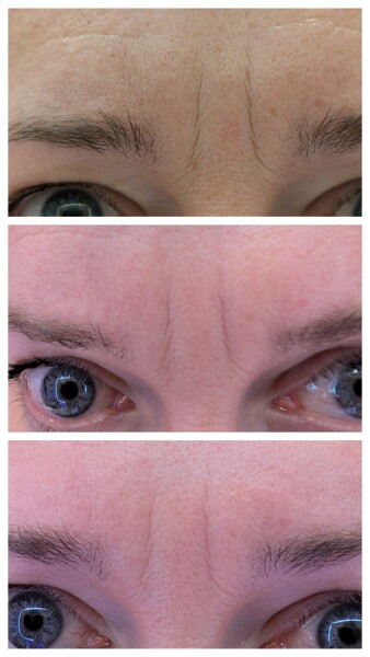 Tretinoin - for fine lines and wrinkles at 58?