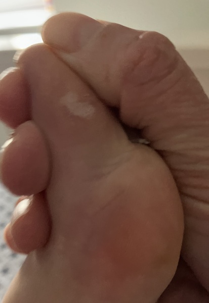 Is this a verruca? White patch on toe