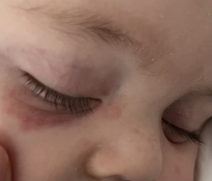 5 month old eczema type rash around eyes