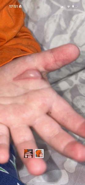 1 year old burnt hand on straightener - advise