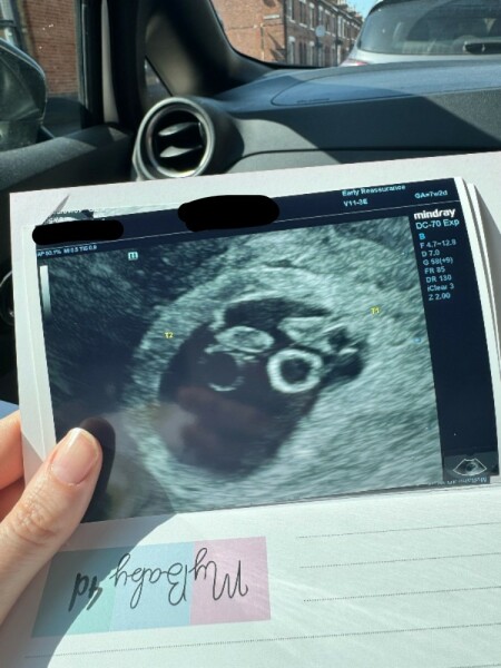 Identical Twin Pregnancy. 7+2 weeks. but one was measure smaller with no heart beat.  help