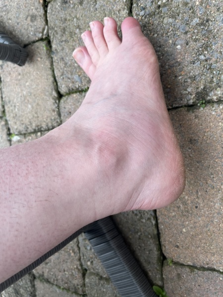 swelling under ankle?