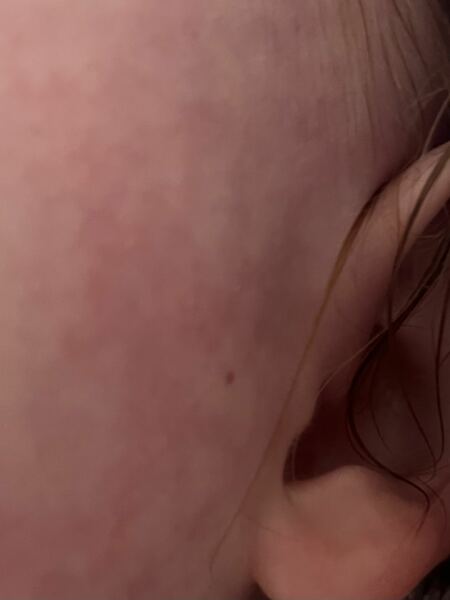 Random non-blanching dots on toddler