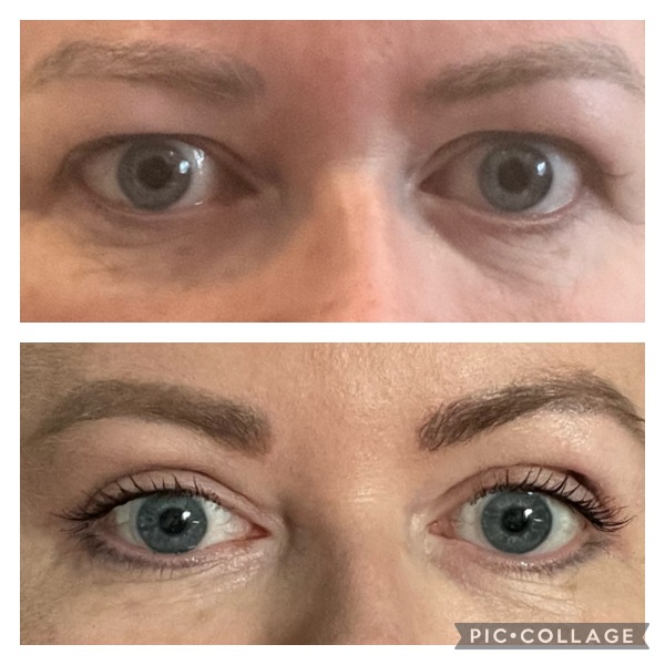 Upper blepharoplasty Monday - HELP!