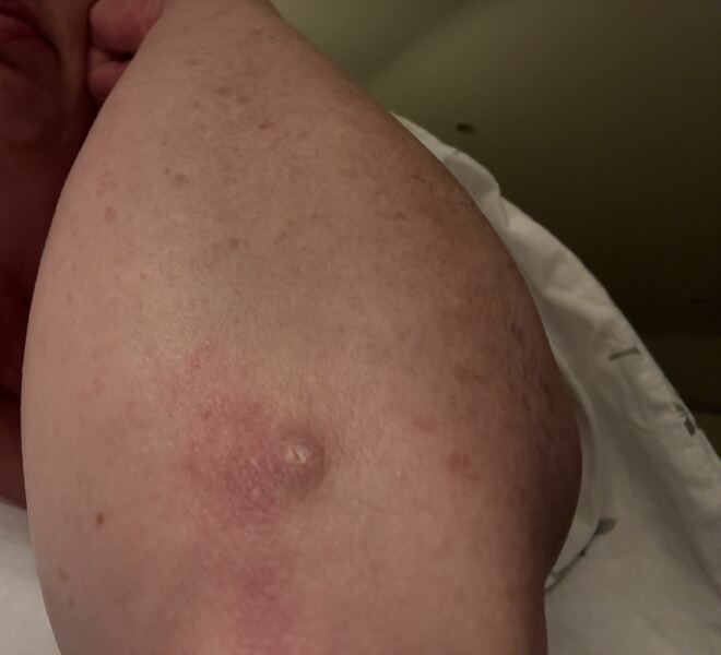 Skin cancer?