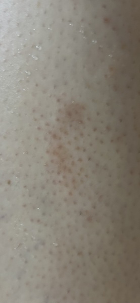 Mark on legs