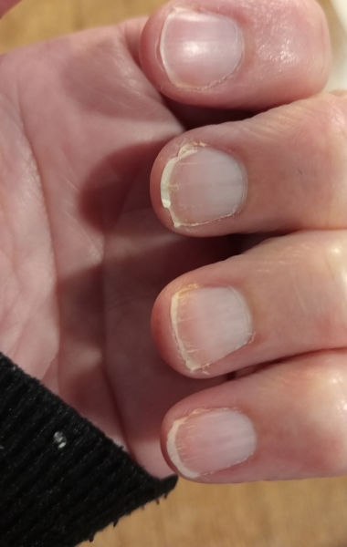 What's wrong with my nails?