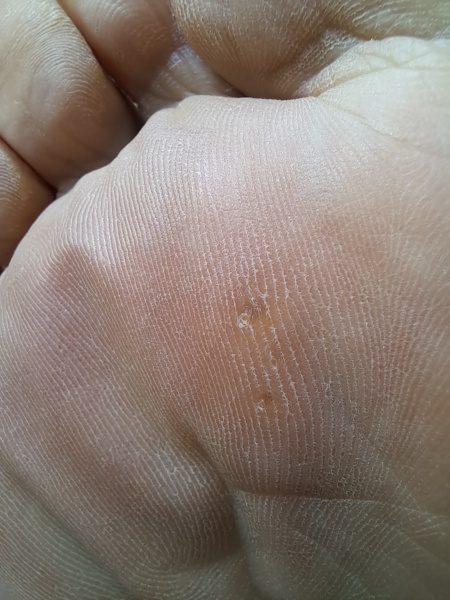 Is this a verruca? Pic attached. Apologies to folk who don't like feet