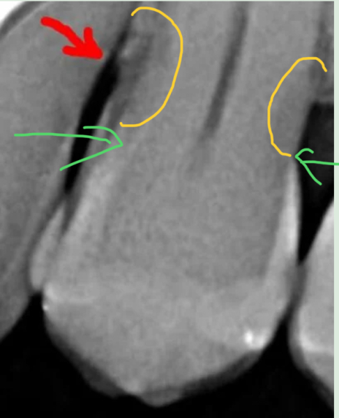 Any dentists around? Could you please tell me if I'm right? Xray