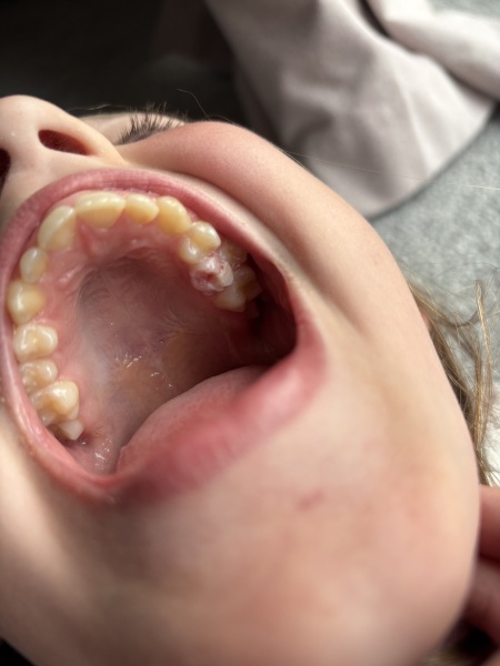Advice please! Child cracked molar. Photos attached!