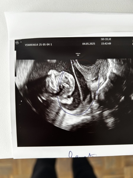 Amniotic sac separated from uterine wall at 17weeks?