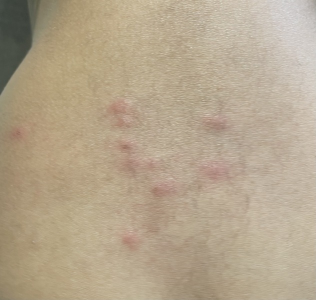 What is this rash?