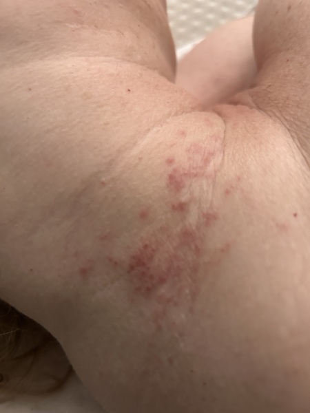 Shingles or heat rash