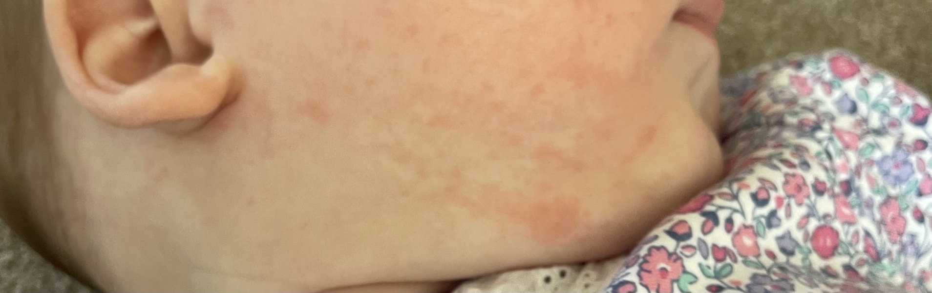 Potential dairy allergy rash? Can anyone help please